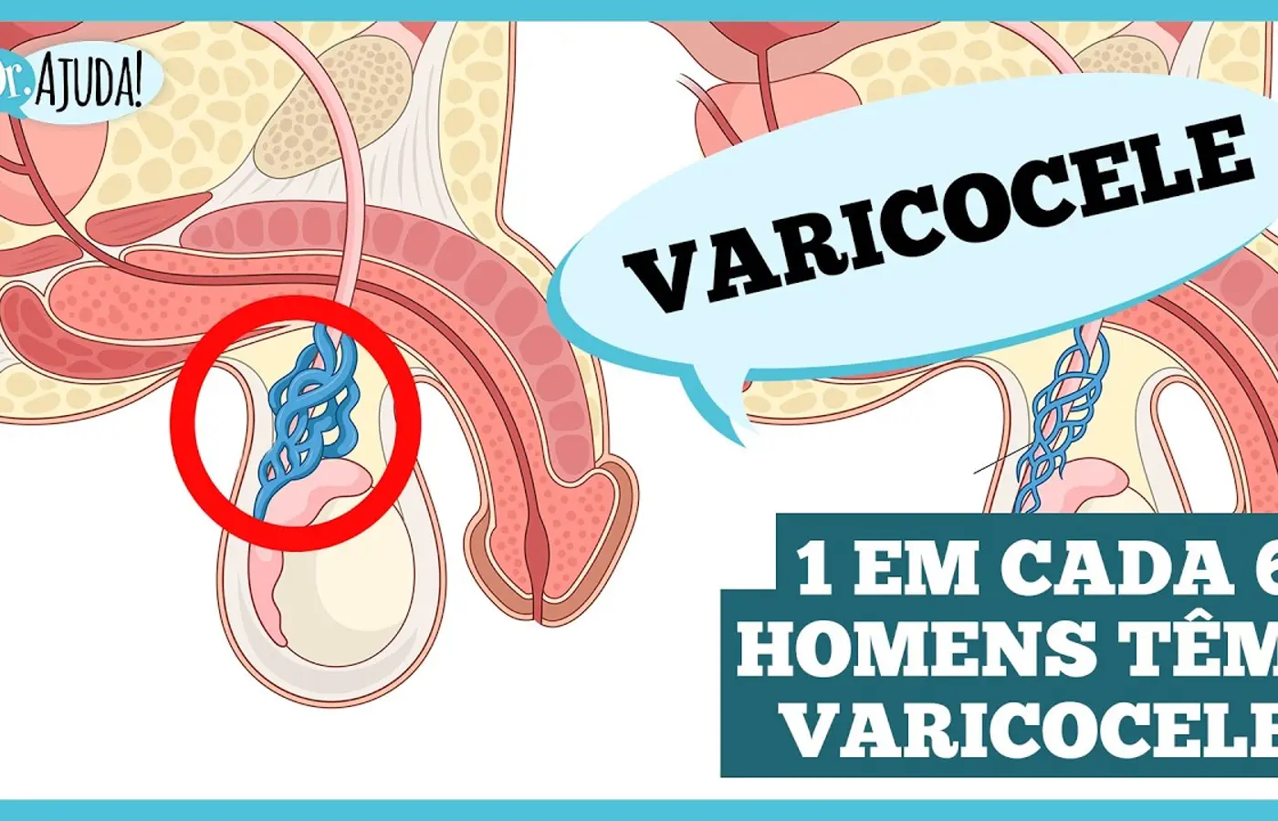 varicocele:-o-que-e-importante-saber?
